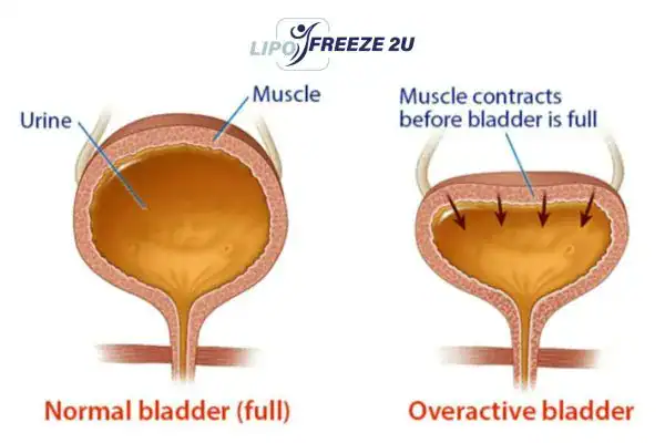diagram of overactive bladder treatment East Grinstead
