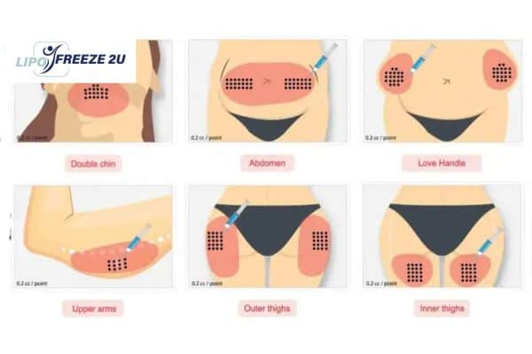 Benefits of Choosing Aqualyx for Fat Reduction East Grinstead