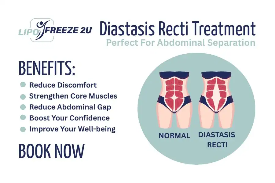 Benefits of body toning treatment East Grinstead for Diastasis recti