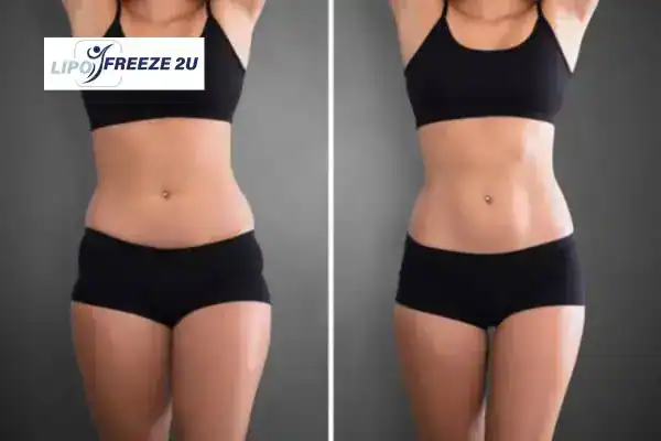 How Can LIPO FREEZE 2U Support Your Post-Pregnancy Body Recovery East Grinstead?