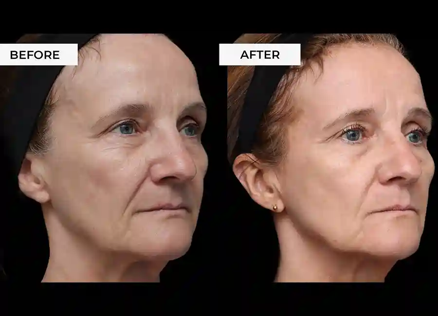 How Many RF Microneedling Sessions Will You Need to See a Difference East Grinstead?