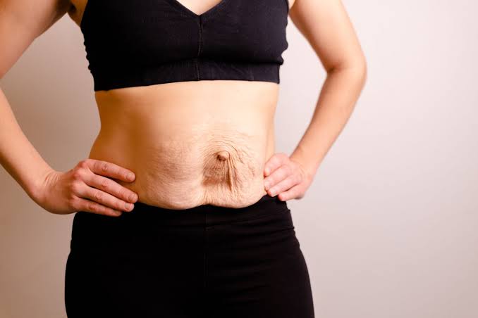 Is Surgery Really the Only Way to Repair Diastasis Recti East Grinstead?