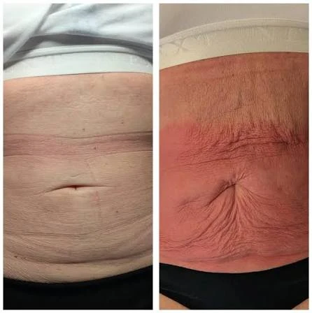 How Does RF Microneedling Improve Crepey, Thin and Uneven Skin Texture East Grinstead?