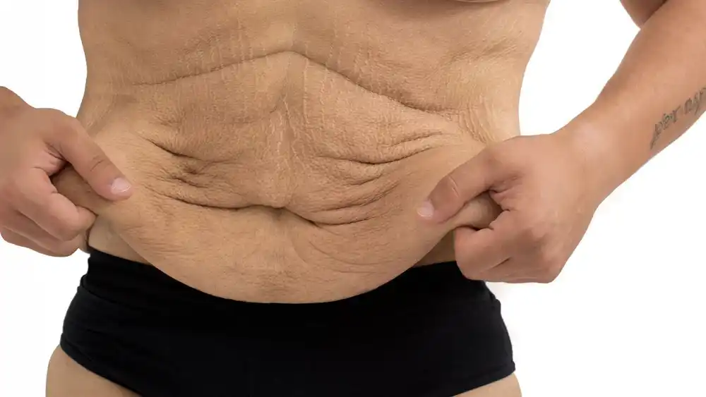 RF Microneedling for Loose Skin: How Can It Help Tighten and Reshape the Skin East Grinstead?
